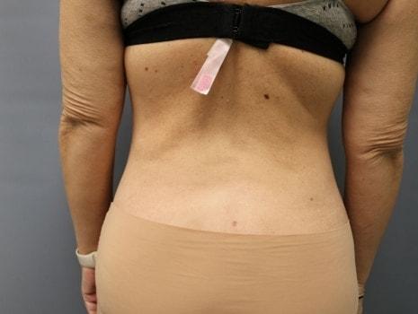 Liposuction after at Orange County Cosmetic Surgery in Huntington Beach, CA