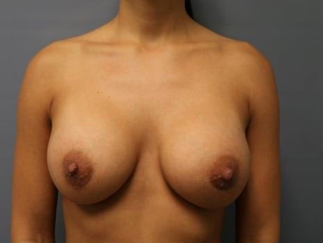 Orange County Cosmetic Surgery breast augmentation after — Huntington Beach, CA