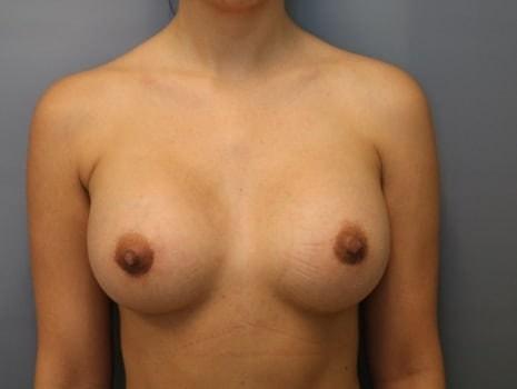 Orange County Cosmetic Surgery breast augmentation after — Huntington Beach, CA