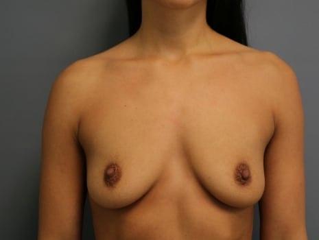 Breast Augmentation before at Orange County Cosmetic Surgery in Huntington Beach, CA