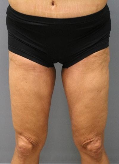 Orange County Cosmetic Surgery thigh lift after — Huntington Beach, CA
