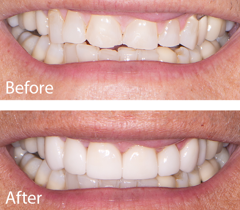 Chase Judd, DDS Family and Cosmetic Dentistry veneers result — Draper, UT