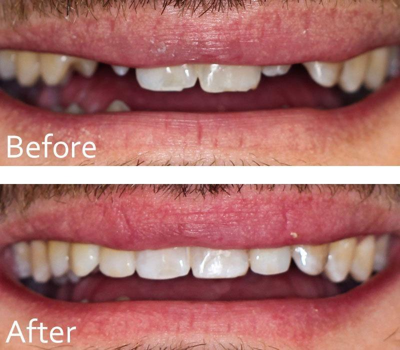 Chase Judd, DDS Family and Cosmetic Dentistry smile makeover result — Draper, UT