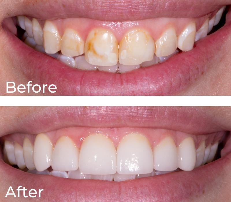 Chase Judd, DDS Family and Cosmetic Dentistry veneers result — Draper, UT