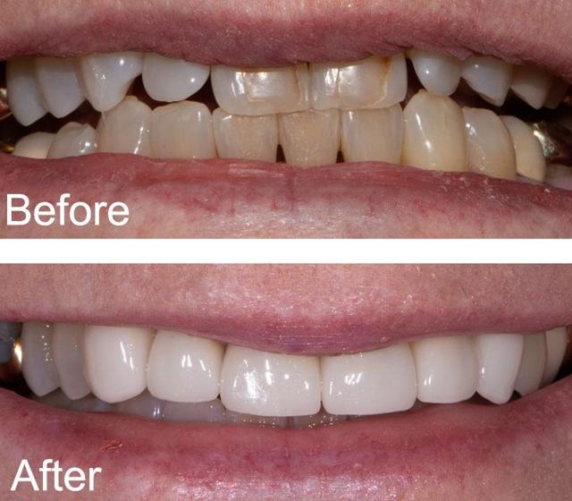 Dental Veneers result at Chase Judd, DDS Family and Cosmetic Dentistry in Draper, UT