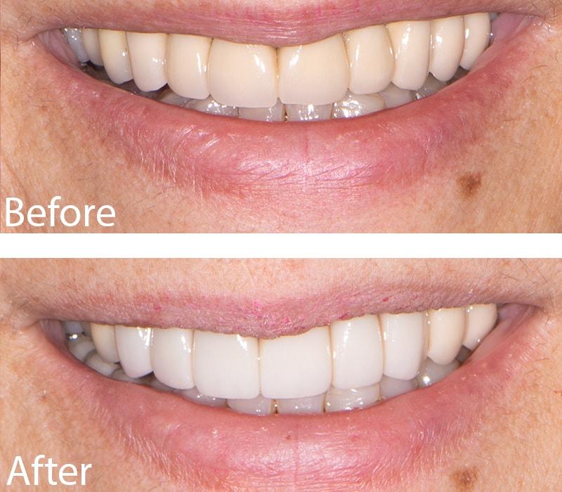 Chase Judd, DDS Family and Cosmetic Dentistry smile makeover result — Draper, UT