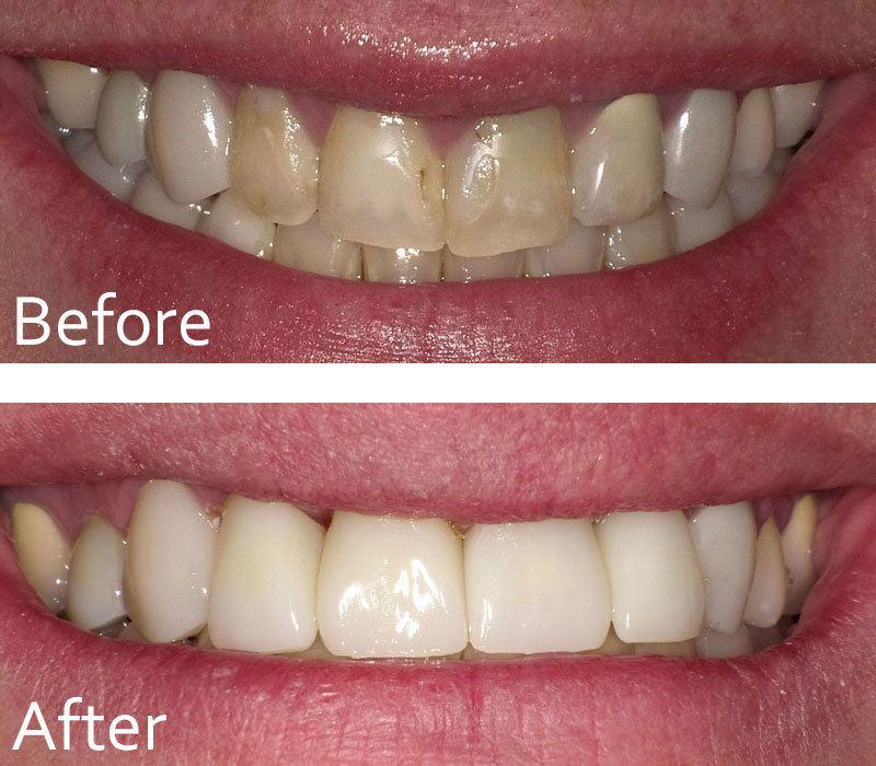 Chase Judd, DDS Family and Cosmetic Dentistry veneers result — Draper, UT