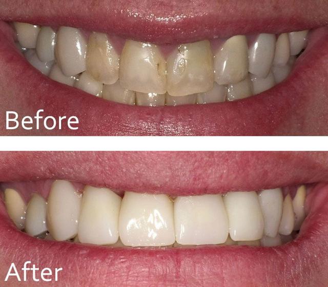 Dental Veneers result at Chase Judd, DDS Family and Cosmetic Dentistry in Draper, UT