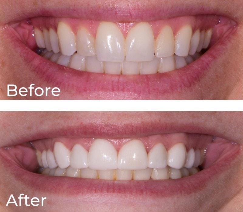 Chase Judd, DDS Family and Cosmetic Dentistry smile makeover result — Draper, UT
