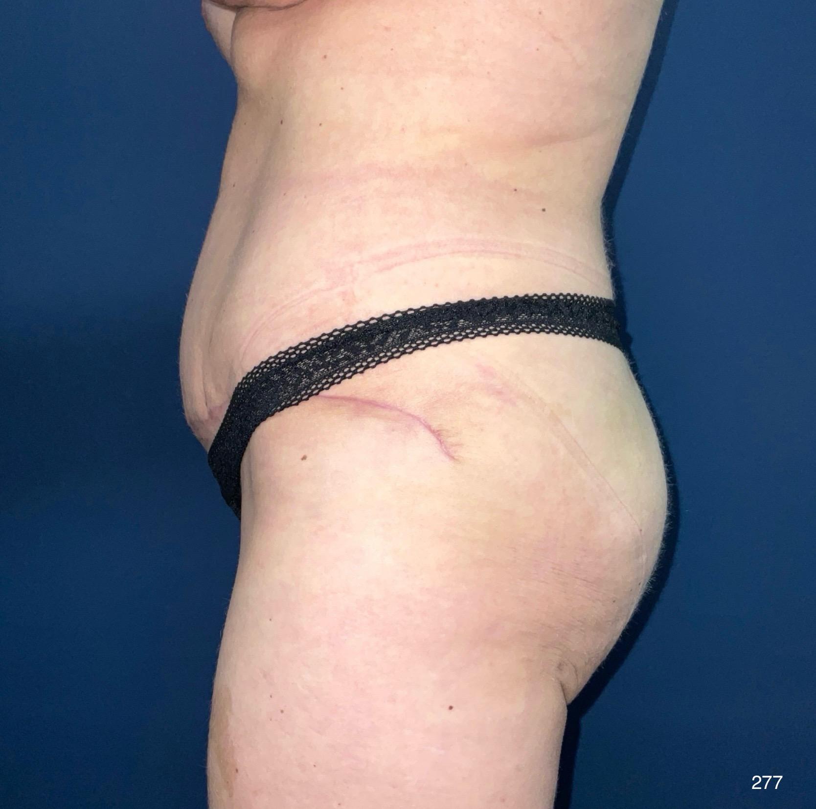 Austin Plastic Surgery Institute and Skincare Clinic tummy tuck after — Austin, TX