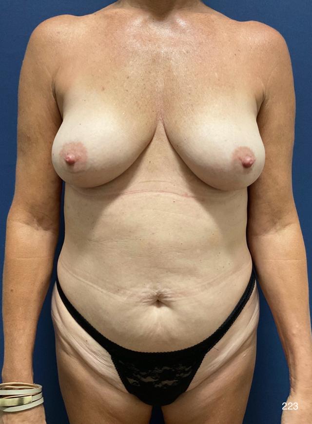Mommy Makeover before at Austin Plastic Surgery Institute and Skincare Clinic in Austin, TX