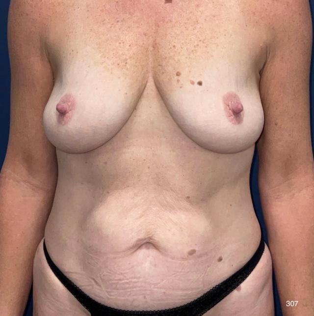 Mommy Makeover before at Austin Plastic Surgery Institute and Skincare Clinic in Austin, TX