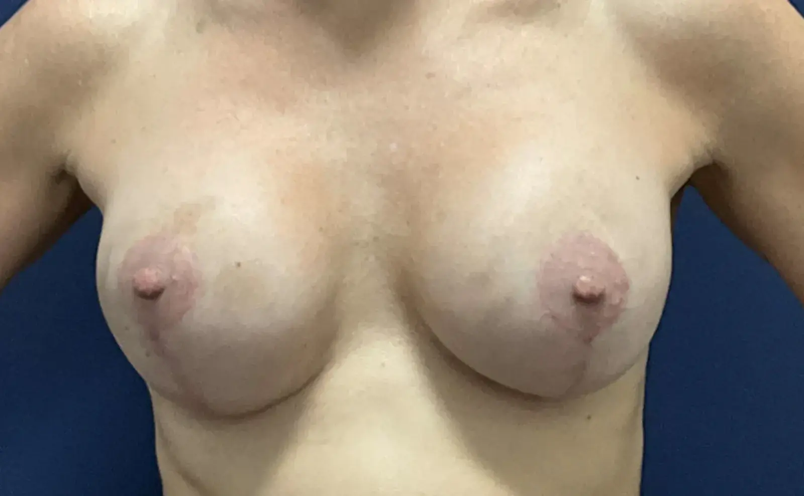 Austin Plastic Surgery Institute and Skincare Clinic breast lift after — Austin, TX