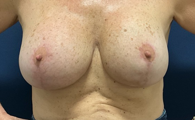 Breast Lift after at Austin Plastic Surgery Institute and Skincare Clinic in Austin, TX