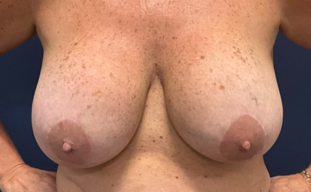 Breast Lift before at Austin Plastic Surgery Institute and Skincare Clinic in Austin, TX
