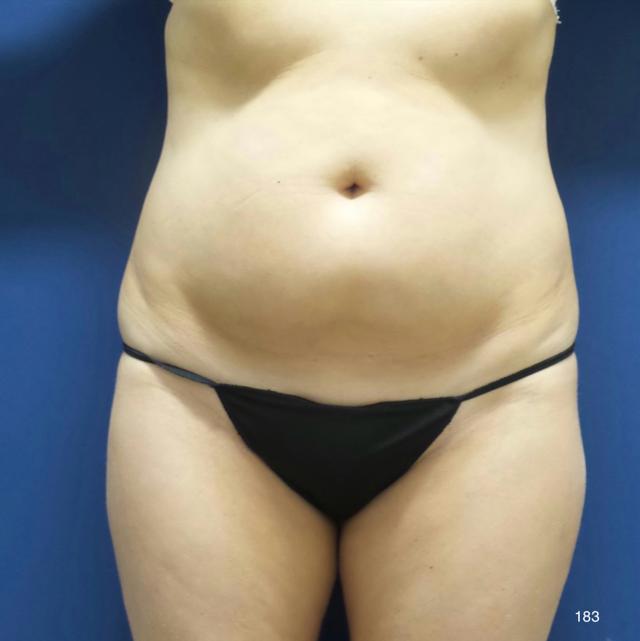 Tummy Tuck before at Austin Plastic Surgery Institute and Skincare Clinic in Austin, TX