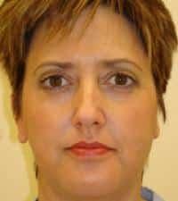 Sacramento Surgical Arts facelift after — Sacramento, CA
