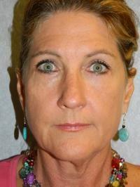 Sacramento Surgical Arts eyelid lift after — Sacramento, CA
