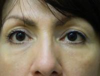 Sacramento Surgical Arts eyelid lift after — Sacramento, CA