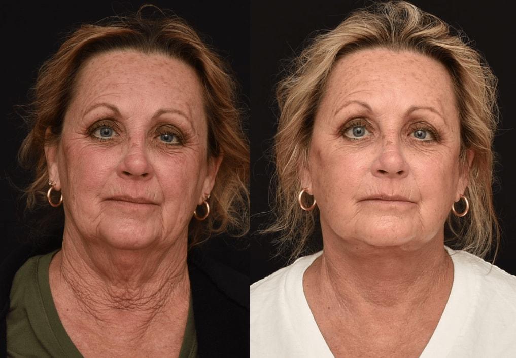 Brian P. Dickinson, MD facelift result — Newport Beach, CA