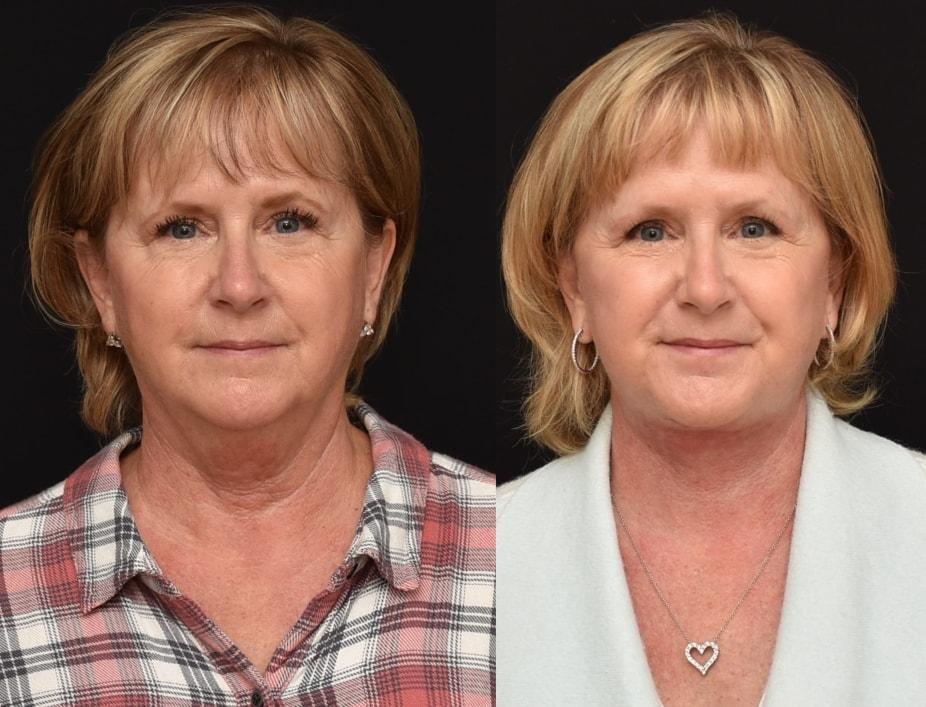 Brian P. Dickinson, MD facelift result — Newport Beach, CA