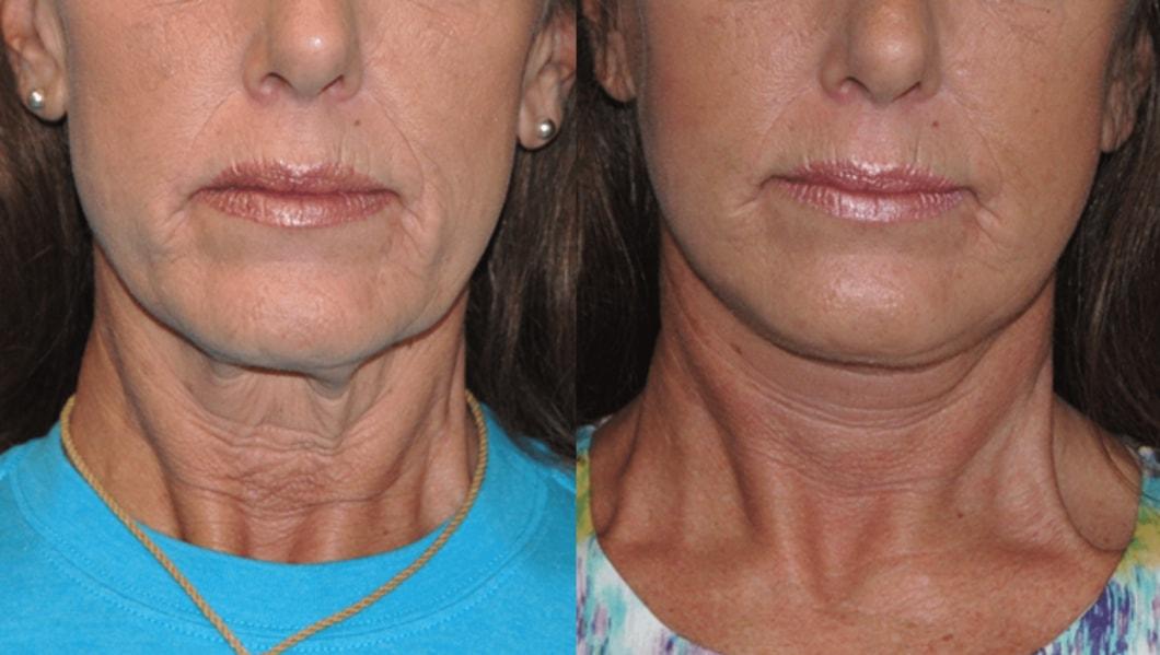 Brian P. Dickinson, MD facelift result — Newport Beach, CA
