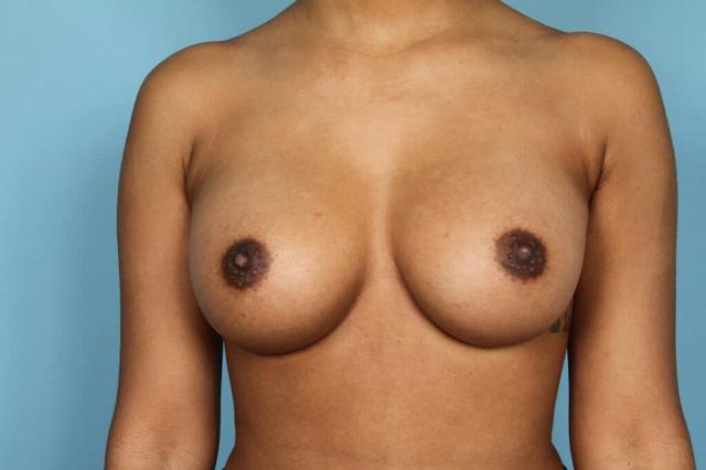 Breast Augmentation after at Marco Ellis, MD in Chicago, IL