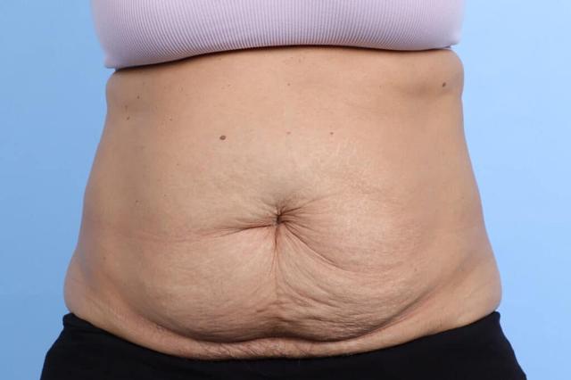 Tummy Tuck before at Marco Ellis, MD in Chicago, IL