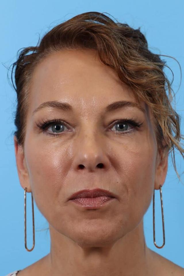 Brow Lift before at Marco Ellis, MD in Chicago, IL