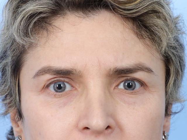Brow Lift before at Marco Ellis, MD in Chicago, IL