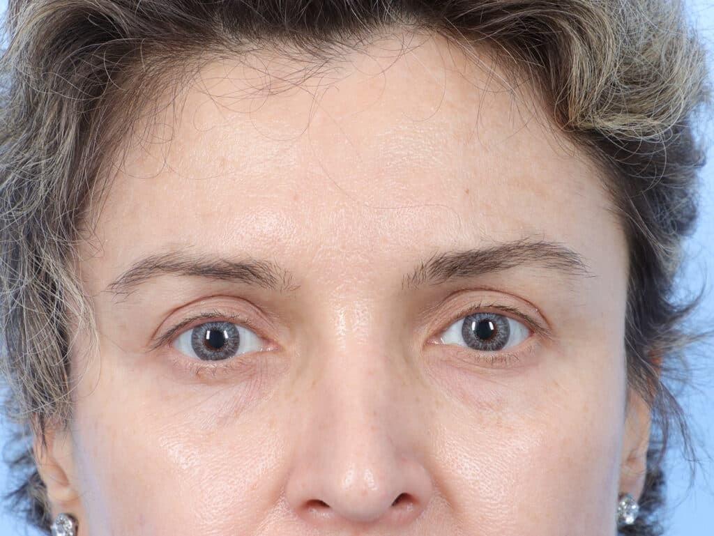 Marco Ellis, MD brow lift after — Chicago, IL