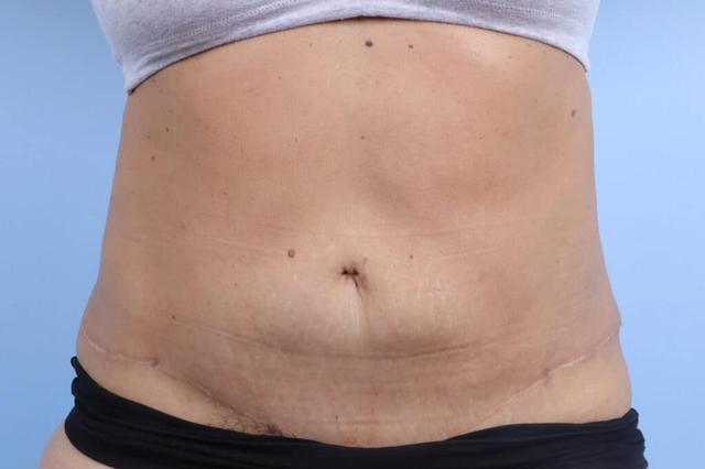 Tummy Tuck after at Marco Ellis, MD in Chicago, IL