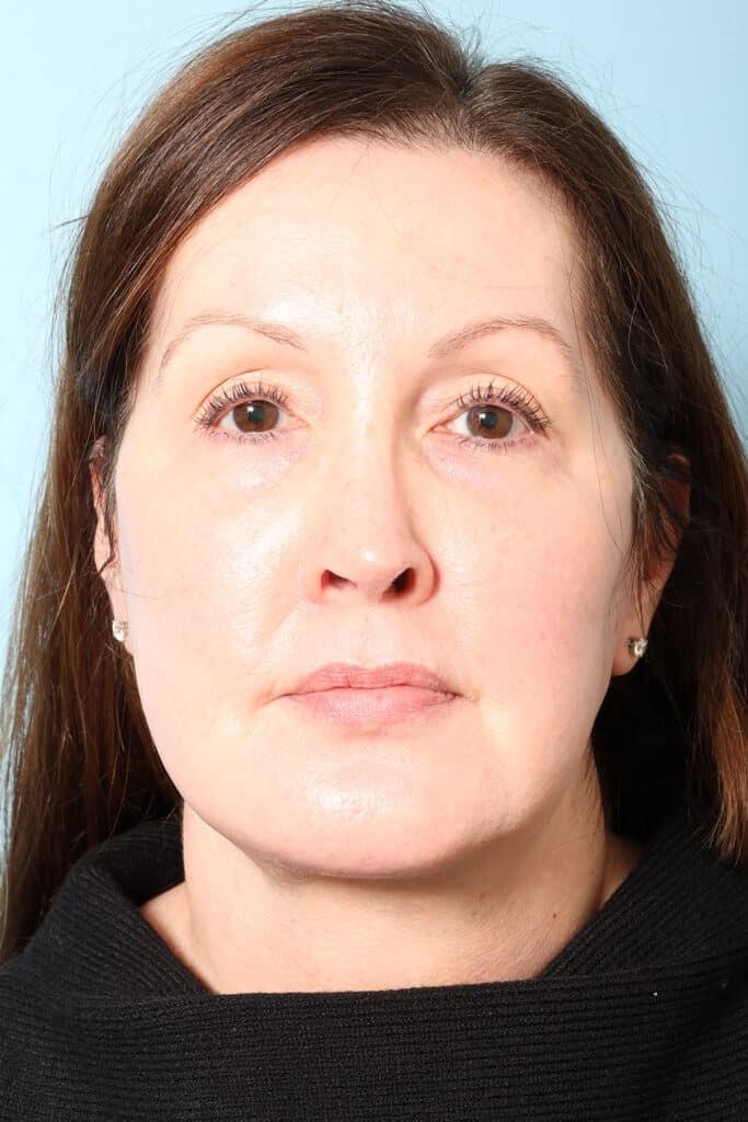 Marco Ellis, MD facelift after — Chicago, IL