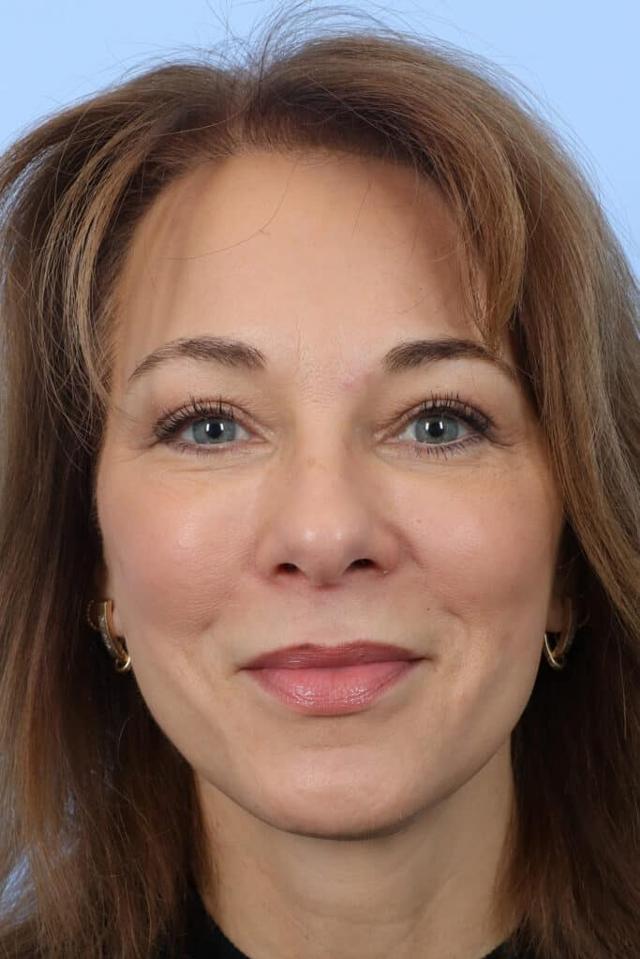 Brow Lift after at Marco Ellis, MD in Chicago, IL