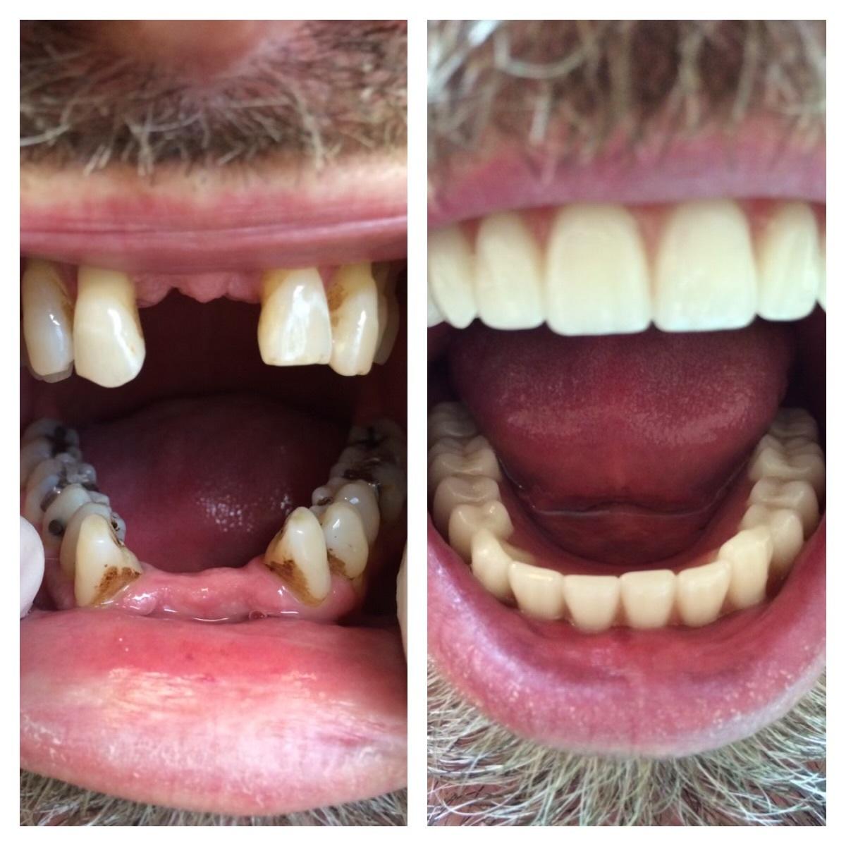 Parkway Dental smile makeover result — St. George, UT
