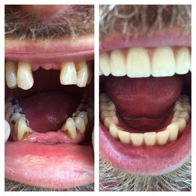 Smile Makeover result at Parkway Dental in St. George, UT