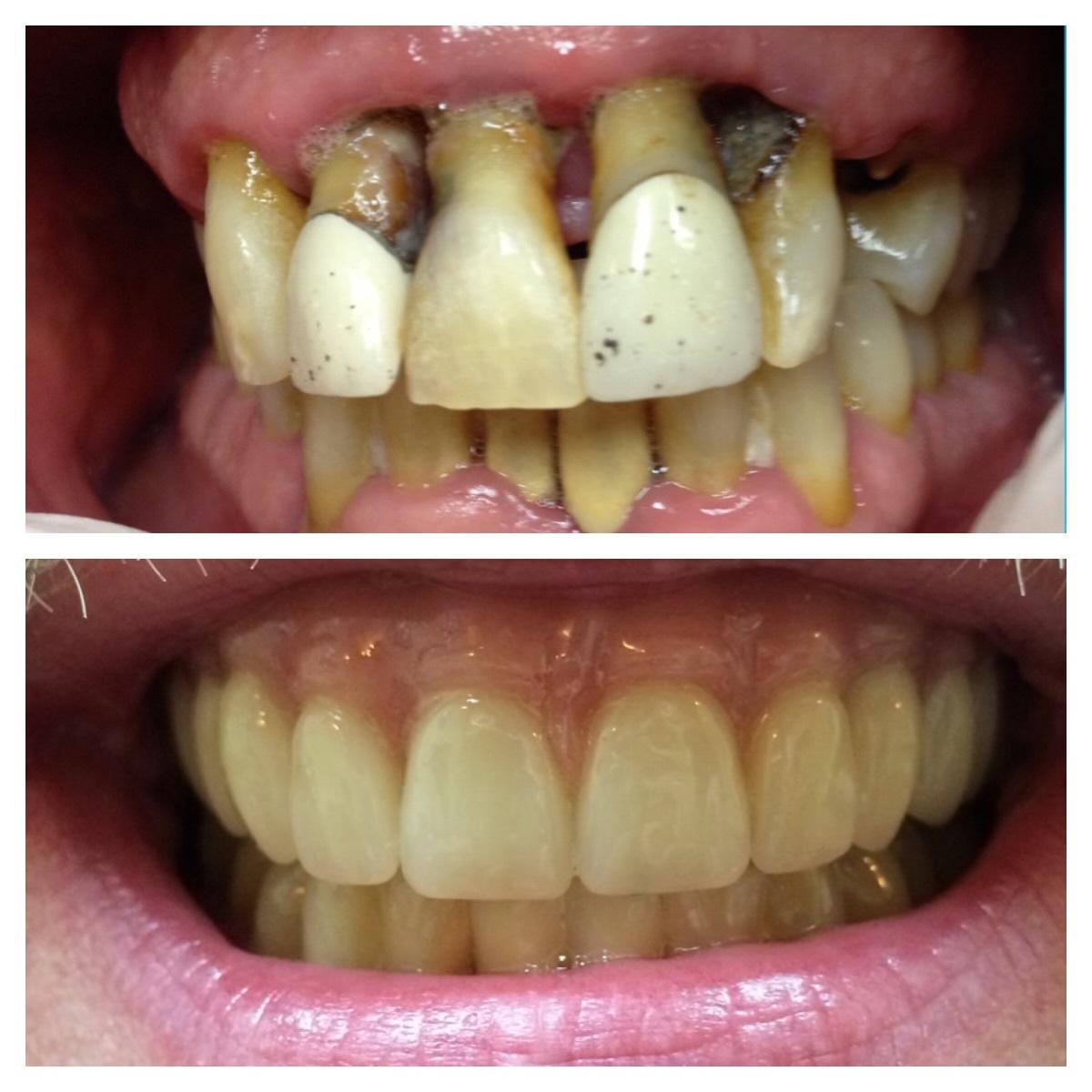 Parkway Dental smile makeover result — St. George, UT