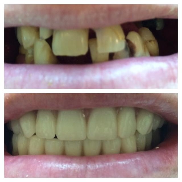 Smile Makeover result at Parkway Dental in St. George, UT