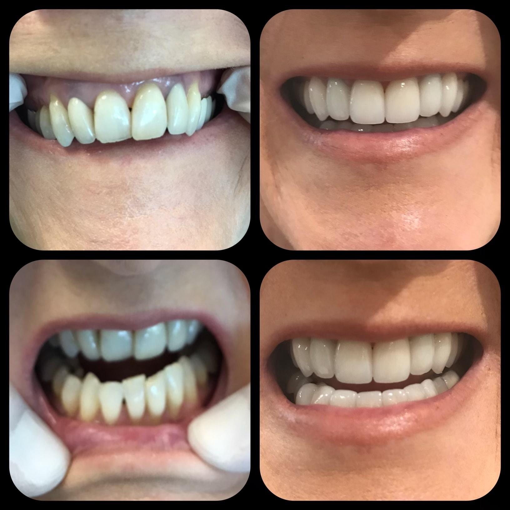 Parkway Dental veneers result — St. George, UT