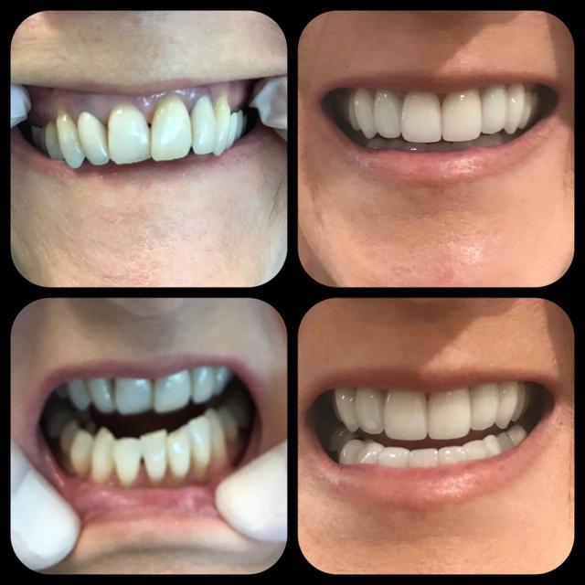 Smile Makeover result at Parkway Dental in St. George, UT