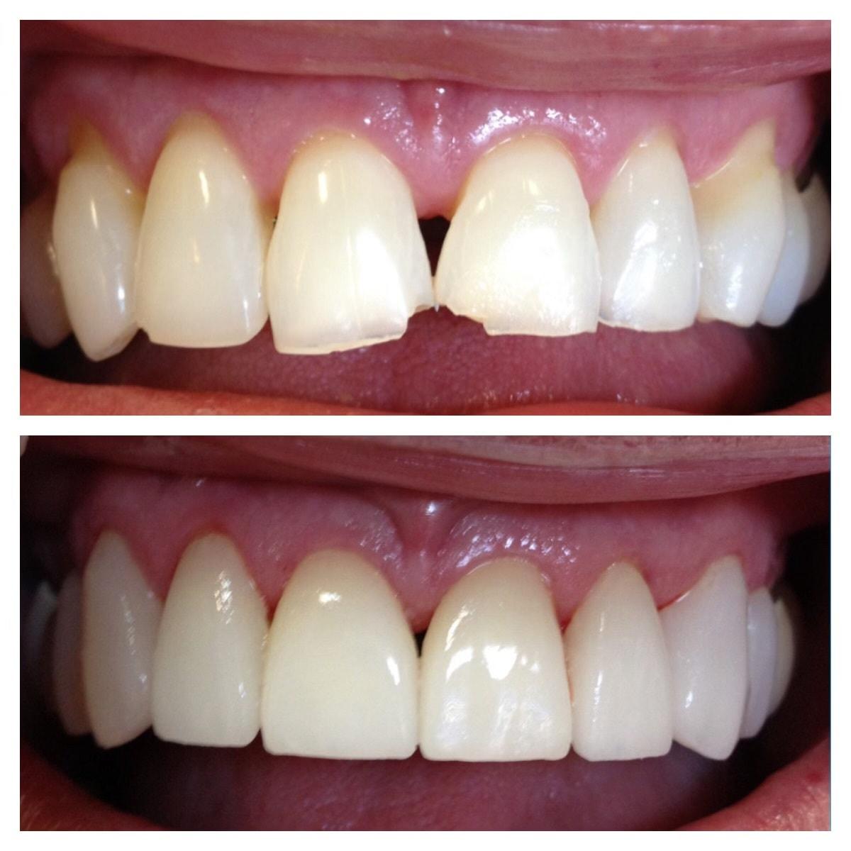 Parkway Dental veneers result — St. George, UT