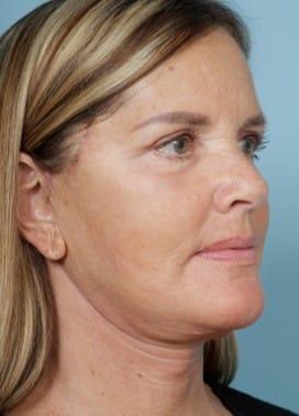 Facelift after at John Kim, MD, FACS in Chicago, IL