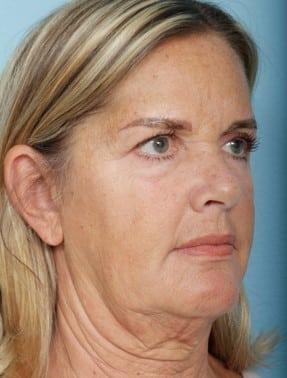 Facelift before at John Kim, MD, FACS in Chicago, IL