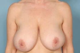 Breast Reduction before at John Kim, MD, FACS in Chicago, IL
