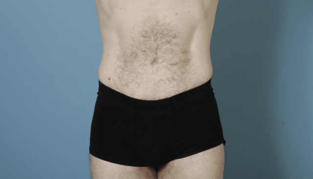 Tummy Tuck result at John Kim, MD, FACS in Chicago, IL