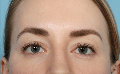 Blepharoplasty after at John Kim, MD, FACS in Chicago, IL
