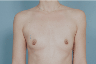 Breast Augmentation before at John Kim, MD, FACS in Chicago, IL