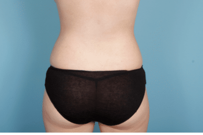 Liposuction after at John Kim, MD, FACS in Chicago, IL