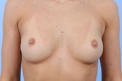 Breast Augmentation before at John Kim, MD, FACS in Chicago, IL