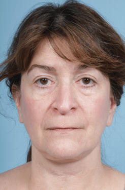 Facelift after at John Kim, MD, FACS in Chicago, IL